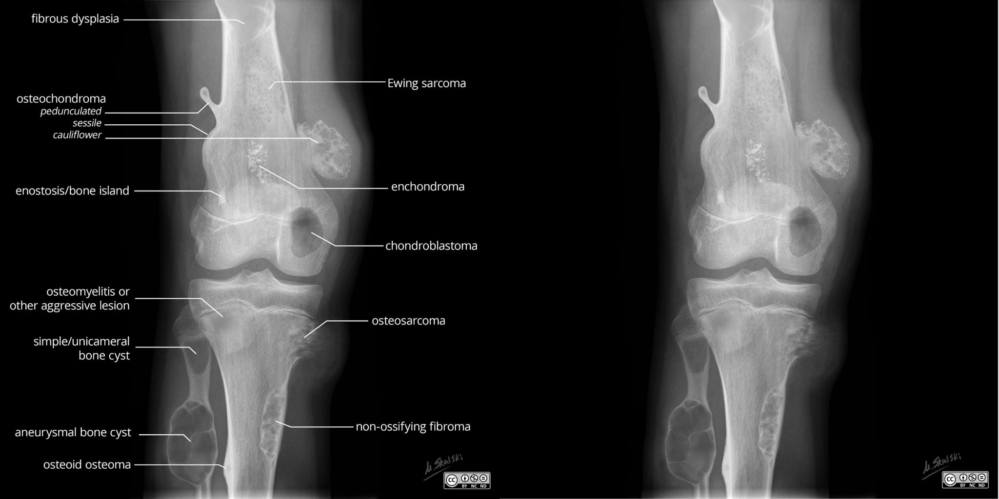 Benign and Malignant (age less than 30) Bone Lesions Illustration Knee ...