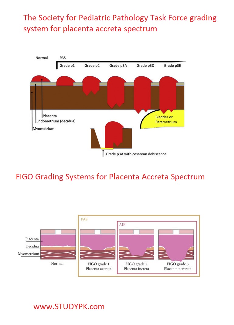 spp-and-figo-grading-systems-for-placenta-accreta-spectrum-medicalkidunya